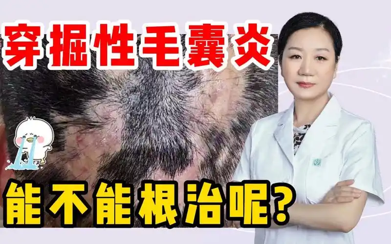 穿掘性毛囊炎能不能根治呢?