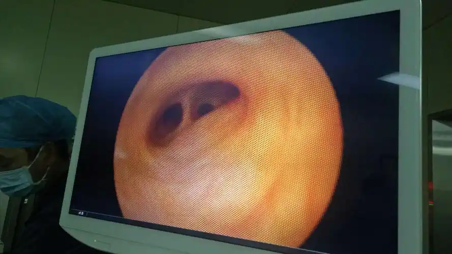 见肝总管轻度扩张,通畅,左右肝管胆汁排泄良好,均无异常.