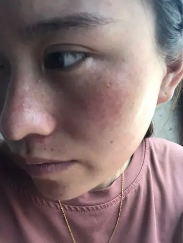 这张脸我已经不知道怎么办了……角质层薄,洗脸不敢洗,护肤品也不敢用