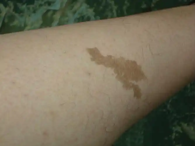 咖啡斑与哪些原因有关-健肤皮肤专科门诊部