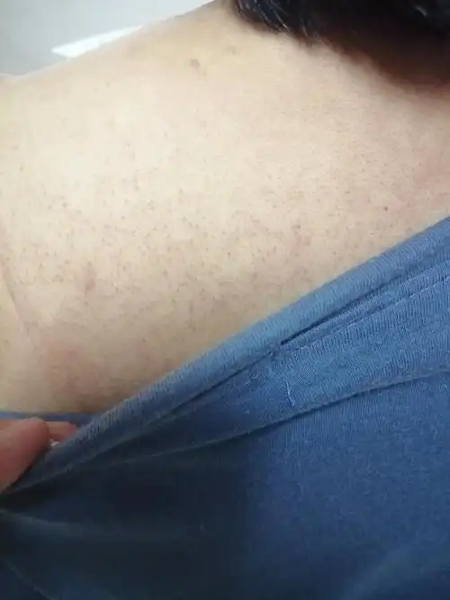 背后一直有黑色的小点点,不敢穿露背的衣服姐妹们.