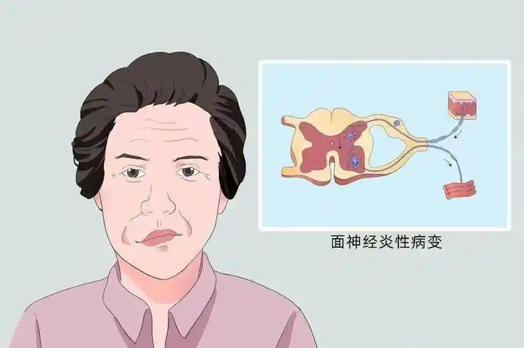 专家提醒:夏季应避免强冷刺激_面神经_面部_科室