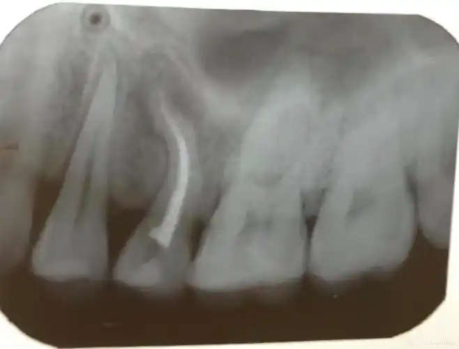 上颌前磨牙s形弯曲根管一例