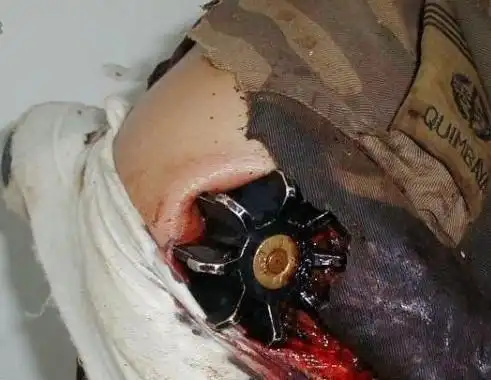 一个士兵被60迫击炮弹贯穿胳膊 治伤的大夫该疯了.