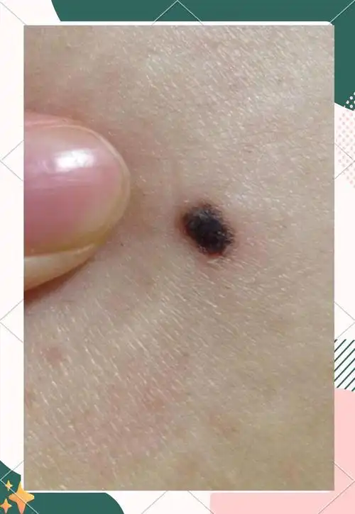 下巴黑痣变大变黑?切掉后恢复如初!