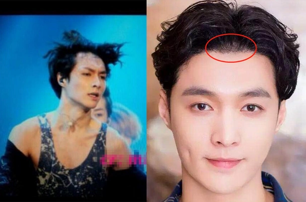 黄晓明植发花了多少钱,史云逊健发中心地址(你就知道黄晓明张艺兴他们