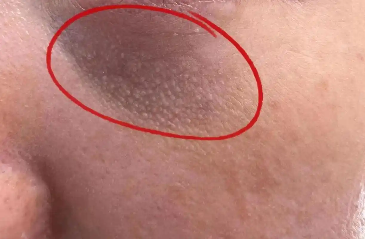 【长在眼睛下面的小疙瘩到底是什么?