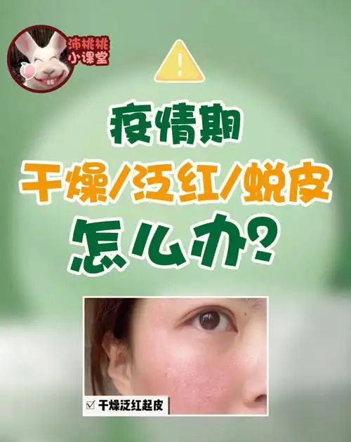 疫情期间在家皮肤干燥起皮发红怎么办