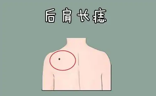 男人的巨富痣和大富痣能注定发大财吗?