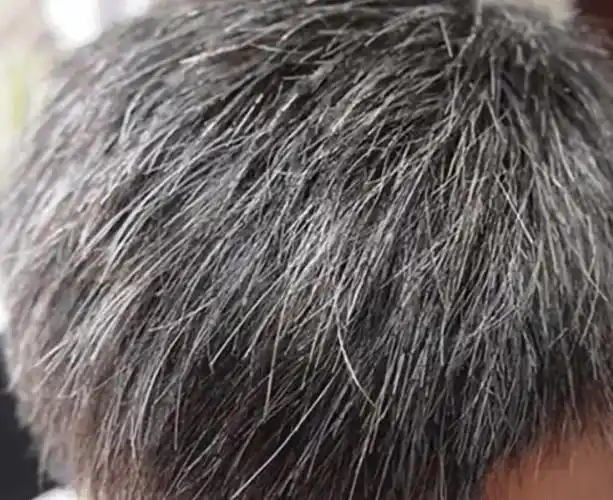 别以为自己老了,医生:或是缺乏2种营养|白头发|维生素|色素|黑发_网易