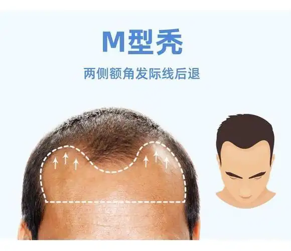 发际线m型该怎么办