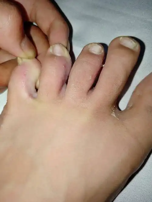 脚烂了又臭脱皮还很痒,挠脚丫后就出水,请问什么情况