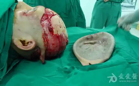 罕见的头皮全层撕脱