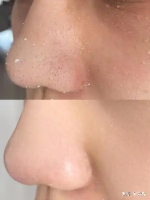 什么方法去黑头比较快