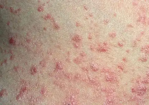 点滴状银屑病是一种皮肤状况,其中出现小的,点状的红色斑块:手臂腿