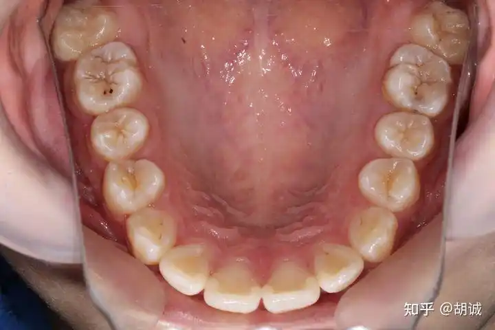 专业医生能不能看出来一个人的牙齿有没有做过矫正呀?