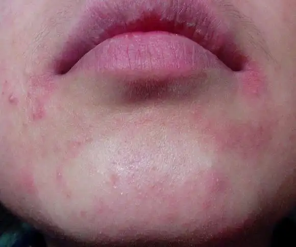 脸上红色一片一片的,应该是皮肤过敏, 是不是刚生完孩子的原因.怎么救