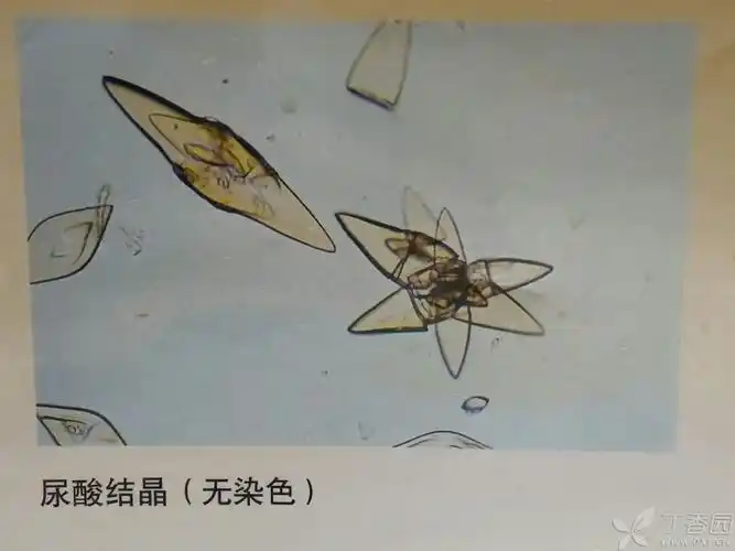 尿沉渣里同一视野可见不同形态的尿酸盐结晶,高倍镜下和油镜下未染色