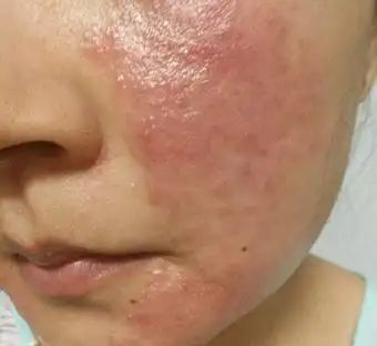 合法!过敏性湿疹怎么治疗"为你介绍"-第1张图片-爱康博客