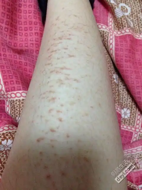 有孕期长疹子的宝妈么