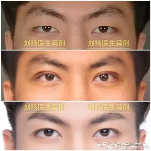 男生割双眼皮前后对比是什么体验