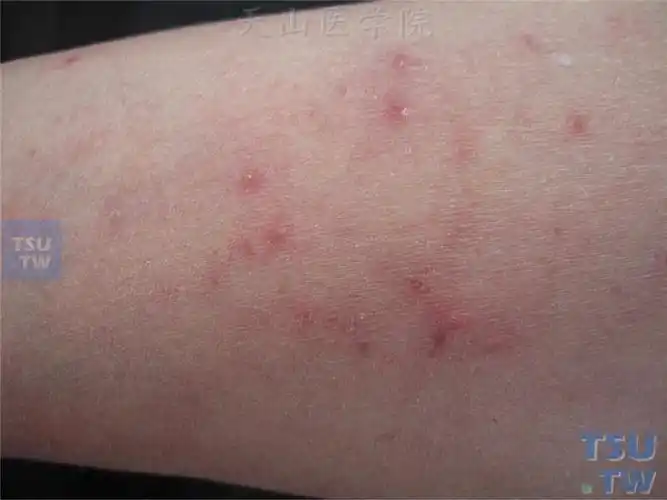 嗜酸性脓疱性毛囊炎的症状表现