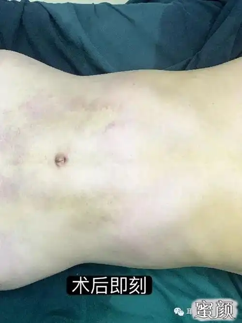 美然当的了大腹婆却炫不了腹深圳腰腹吸脂案例