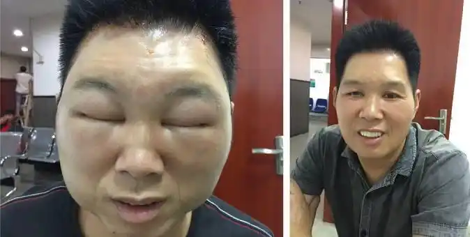 男子满脸肿胀像气球,竟因染发导致过敏!