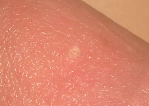 龟头上有一个白色圆环状小圈,直径一毫米,硬质,不痛不痒.时间有2年了.