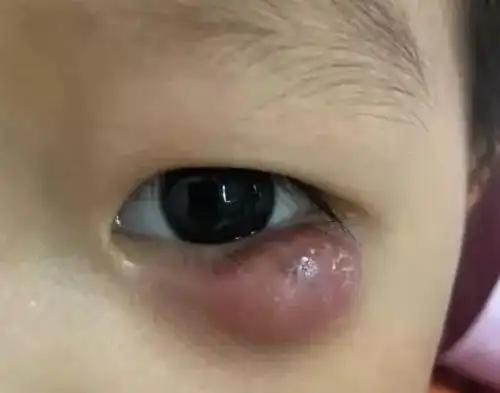 发现霰粒肿不要怕,综合治疗能够解决烦恼_寻医问药频道_寻医问药网