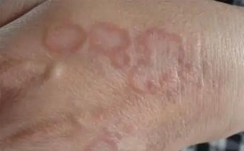 糖尿病并发症:认识形形色色的糖尿病皮肤病变