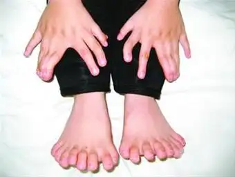 6岁男孩患罕见多指症 散开酷似"莲花掌"(图)