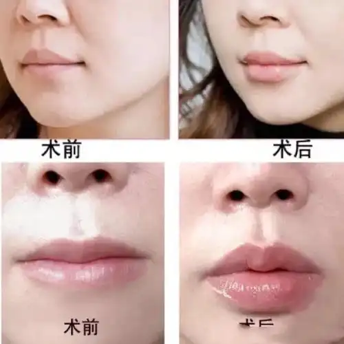 嘟嘟唇到底要不要打