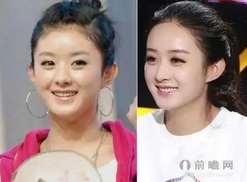 赵丽颖被指整容 早年照片被扒出前后对比惊人