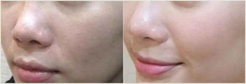 迁安苗方清颜专业祛痘祛疤/问题皮肤修复中心/专业祛痘 祛斑 去痘印