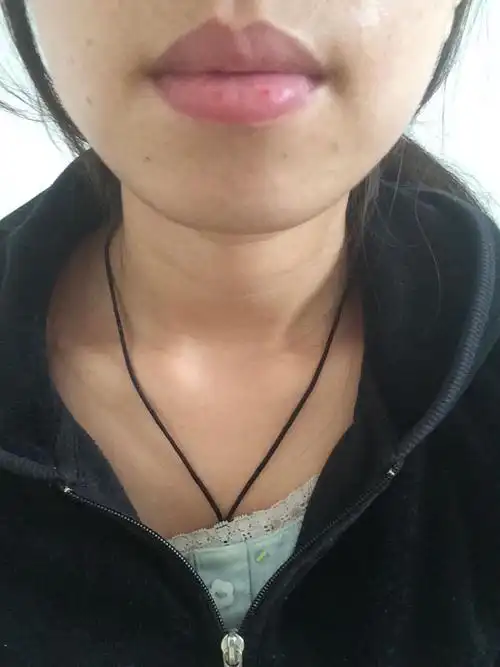 本人侧面看起来凸嘴比较严重,也米有下巴,我有朋友