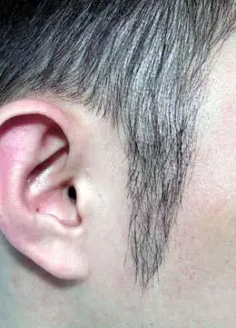 鬓角种植的效果好不好