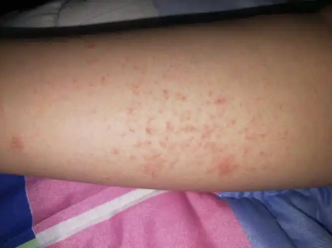 身上长了一片片小红点,不痒.如图