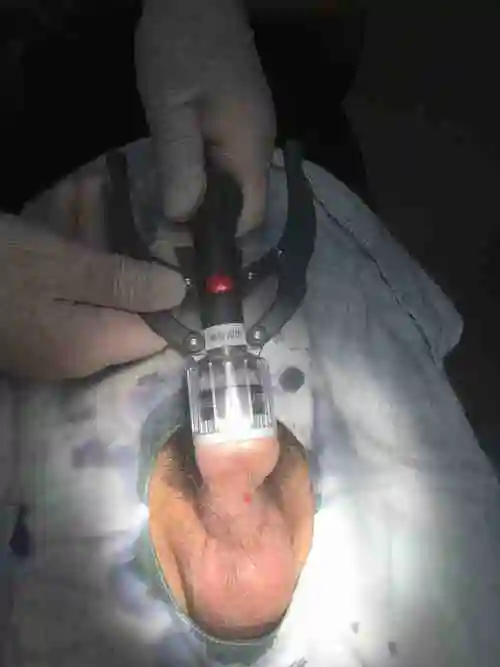 新方法切包皮效果好恢复快