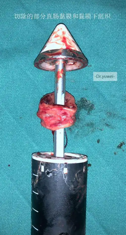 简单的说,就是用吻合器经肛门环形切除部分直肠黏膜和