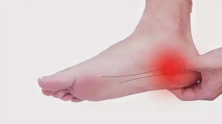 教你六步轻松缓解足底筋膜炎