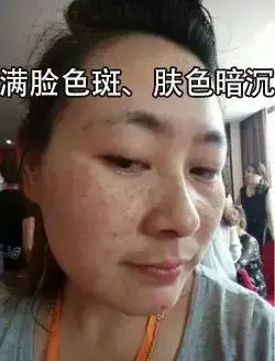 女人脸上有斑老20岁用它抹一抹色斑暗沉全赶走7天白1度
