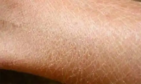 皮肤干燥鱼鳞病怎么治?_治疗_水分_疾病