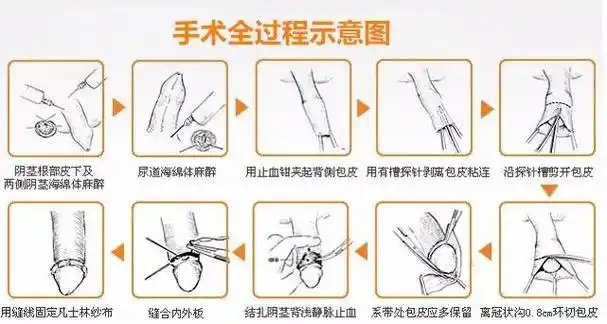 包皮手术前后需要注意哪些