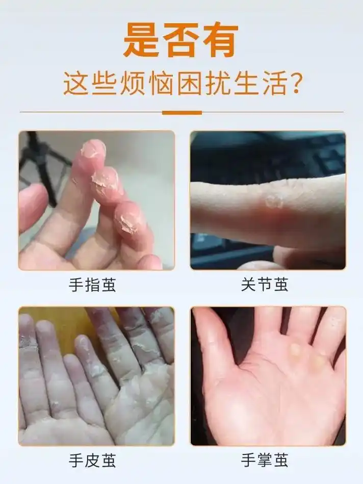 老茧 脚趾旁长有老茧的姐妹们不要再自己剪了,我告诉你个简单 - 抖音