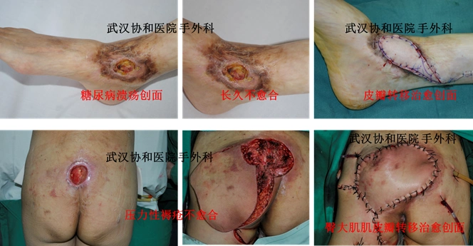 各种外伤性创面的治疗:皮肤缺损,皮肤坏死,骨折外露等;2.