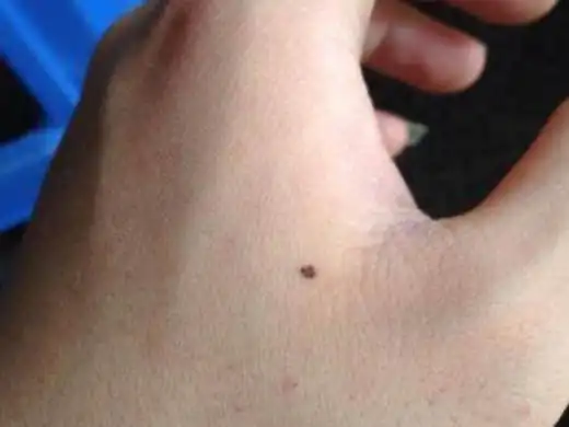 右手长痣代表什么 右手长痣有什么寓意第4步