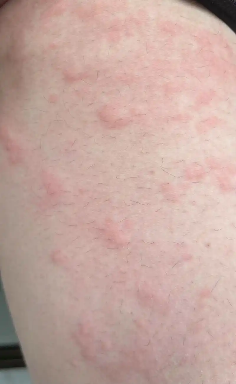 阳康后每天这样皮肤过敏的,抗过敏的药也吃了,有同款,有没有什 - 抖音