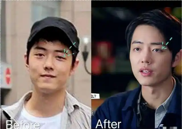 看脸博主直言王一博做了鼻翼缩小,还称其注射玻尿酸导致鼻子挛缩|整容