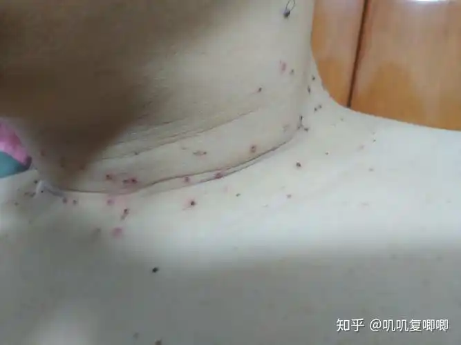 丝状疣脖子上女性医生说要激光扫有别的办法吗